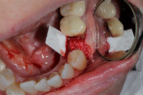 Bone Grafting After Tooth Removal Why When And What To Use Perio