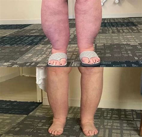 Lipedema Before And After Photos Of Lipedema Surgery Results