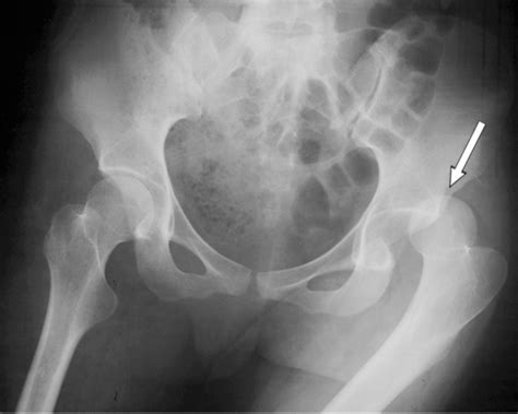 Avn may happen in 20% or more of people who dislocate a hip. Dislocated Hip Symptoms, Diagnosis and Treatments | HSS