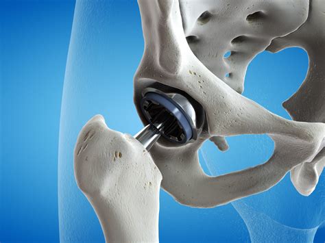 Best Hip Joint Replacement Surgery In Kanpur