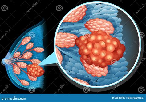 Breast Cancer Diagram Close Up Stock Vector Illustration Of