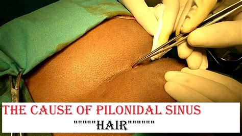 Pilonidal Sinus Cause Hair Avoid Excessive Hairpersonal Hygiene