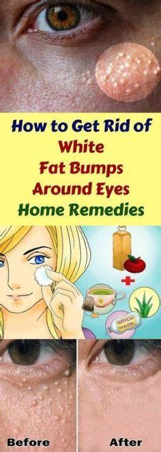 How To Get Rid Of Wh Bumps Under Eyes Skin Care Treatments Skin