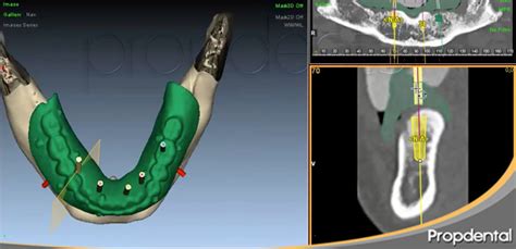 Two types of stereolithographic templates are currently available: Computer guided implant surgery