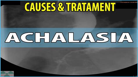 What Is Achalasia Causes Symptoms And Treatments Youtube