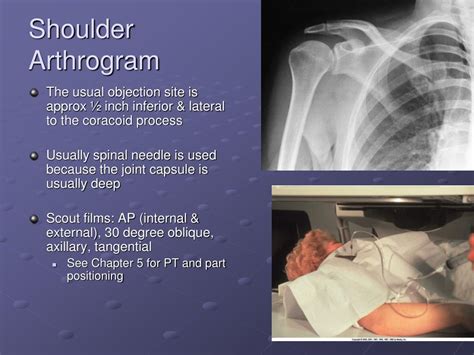 Ppt Arthrography Powerpoint Presentation Free Download Id6595294