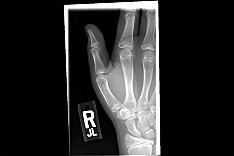 Ortho Dx Thumb Pain Following Soccer Injury Clinical Advisor