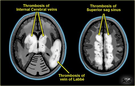 Cerebral Venous Thrombosis Radiology