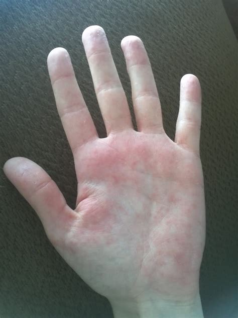 What Does Shingles Look Like On Your Hands