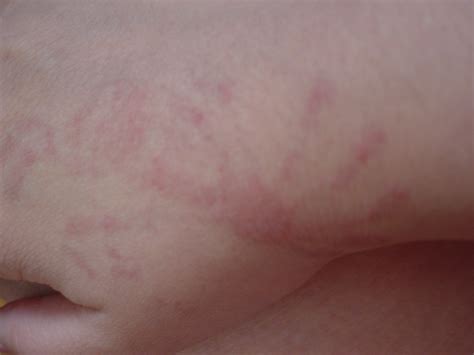 Red Bumps On Back Raised Bumps On The Back Of My Hand