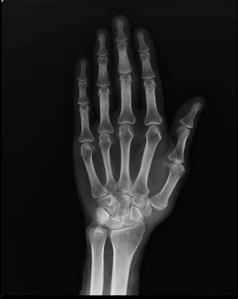 Psoriatic Arthritis Image