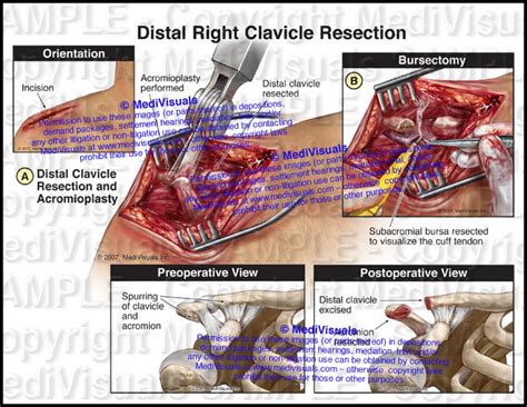 Open Distal Right Clavicle Resection Medivisuals Inc Medivisuals Inc