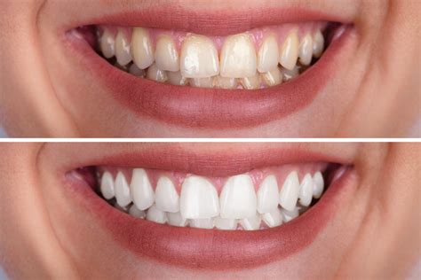 Teeth Whitening Kit Custom Whitening Trays Coolum Dentist