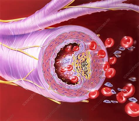 Atherosclerosis Of Artery Artwork Stock Image C0226406 Science