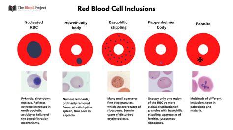 Red Cell Inclusions • The Blood Project