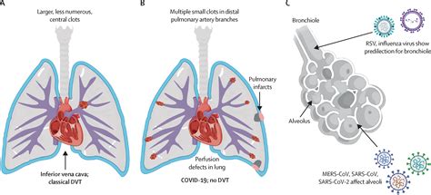 A Tricompartmental Model Of Lung Oxygenation Disruption To Explain