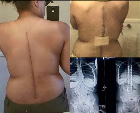 Before After X Rays Of My Spinal Fusion Surgery Weeks After
