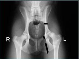A hip dislocation is a disruption of the joint between the femur and pelvis. hip dysplasia triple pelvic osteotomy tpo jps ...