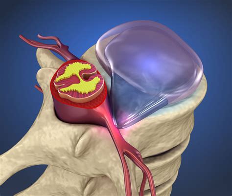 Another term you might hear is ruptured disc. Herniated & Bulging Disc Chiropractor - Beach Pain Center