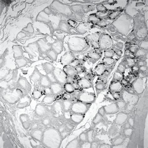 C Cells Hyperplasia In The Upper And Middle Third Of The Lobe Showing