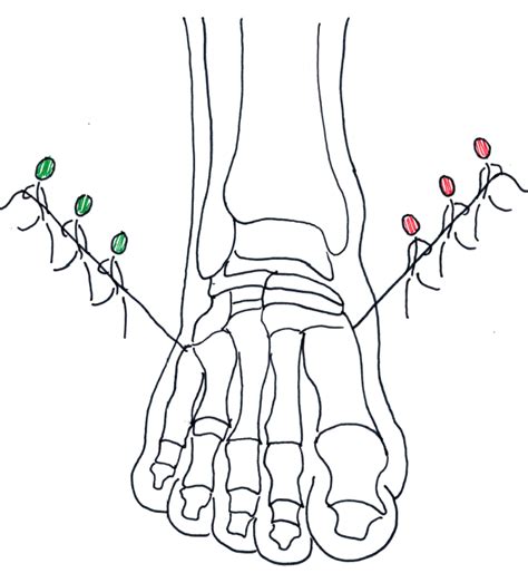 Tarsal Tunnel Syndrome Posterior Tibial Neuralgia Ankle Foot And Orthotic Centre
