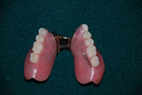 Dentures 19th Avenue Dental