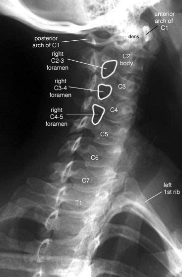 Radiographic Anatomy Of The Skeleton Cervical Spine Right Anterior