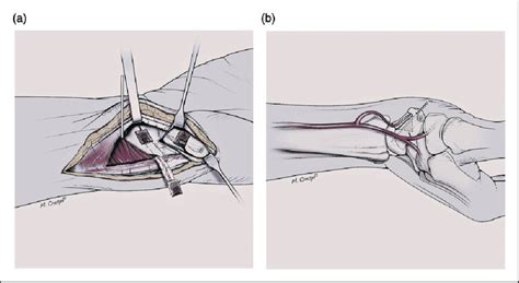 Drawing Summarizing The Principle Of Volar Vascularized Bone Grafting