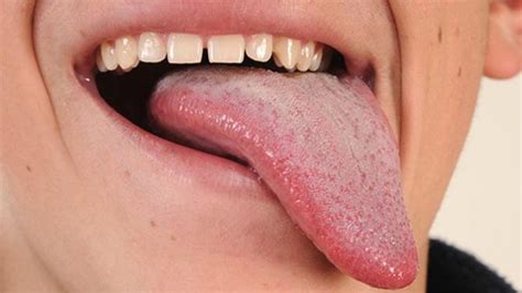 Here Are 3 Things Your Tongue Says About Your Health The Inertia