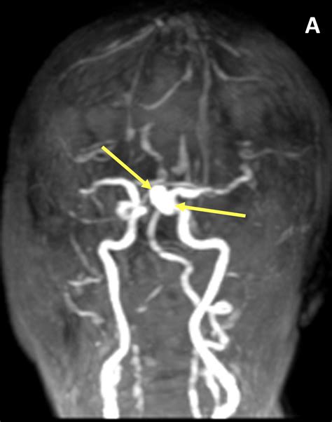 Intracranial Aneurysm Ia Diagnosis Mri Online