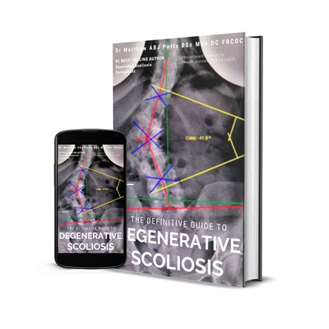 Scoliosis Brace Indirect Uk