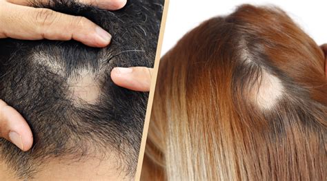 Top Image What Causes Hair Loss Thptnganamst Edu Vn