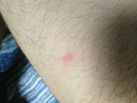 Go on to discover millions of awesome videos and pictures in thousands of other categories. The gallery for --> Herpes Inner Thigh