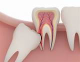 Did it take a long time to stop the bleeding? Wisdom Tooth Extractions San Diego - Dentist in San Diego
