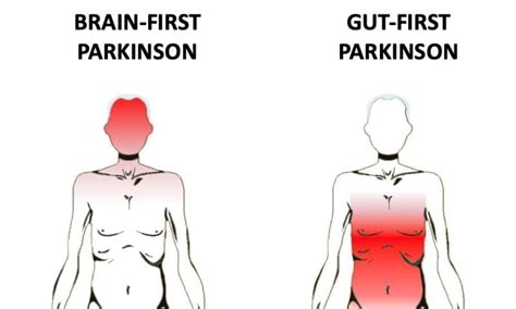 Where Does Parkinsons Disease Start In The Brain Gut Or Both