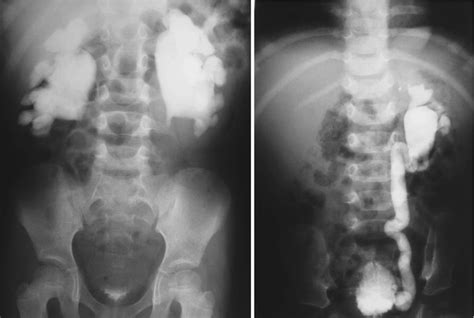 Hydronephrosis In Infants And Children Abdominal Key