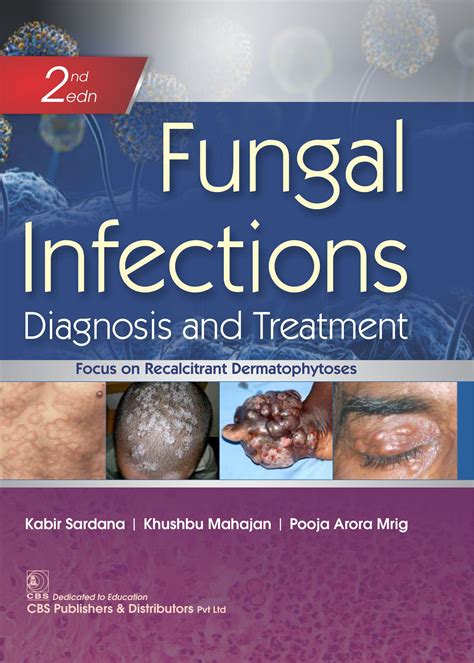 Fungal Infections Diagnosis And Treatment