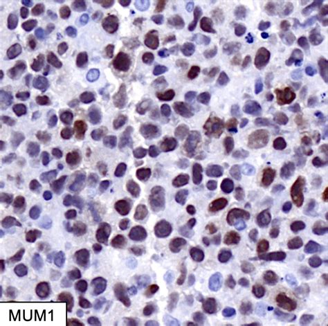 Pathology Outlines Dlbcl Primary Testicular