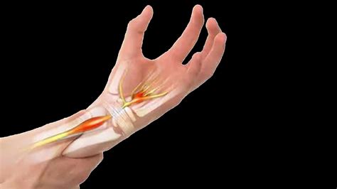Understanding Carpal Tunnel Syndrome Clinical Health Care Radius