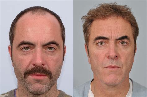 February 15th, 2018 by hasson & wong. James Nesbitt Hair Transplant at HRBR - Latest Results