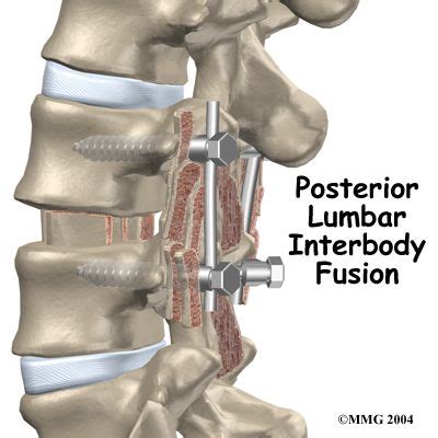 Posterior Lumbar Interbody Fusion Orthogate Spinal Fusion Surgery Spinal Fusion Spine Surgery