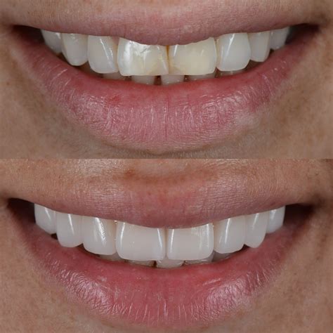 Composite Bonding Milton Keynes Just £250 Per Tooth