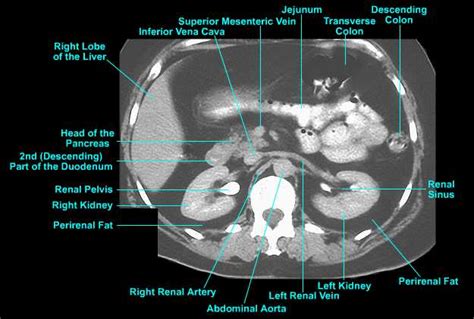 Pancreas Anatomy Ct