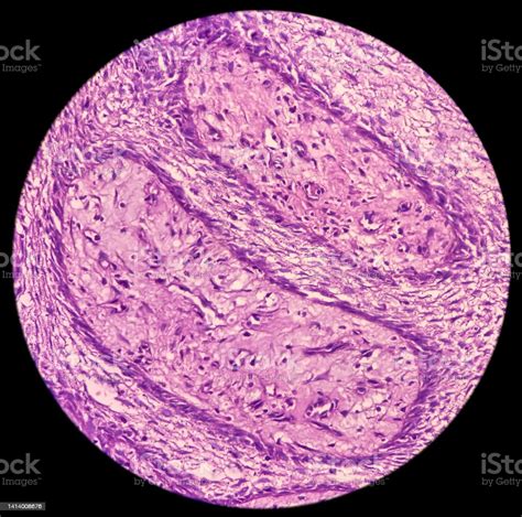 Microscopic Tissue Of Retromolar Region Show Buccal Mucosa Squamous