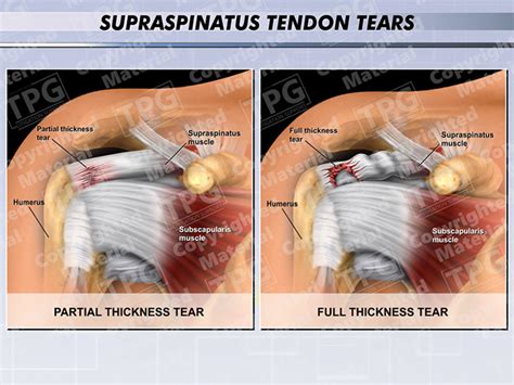 Supraspinatus Tendon Tears Order