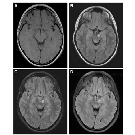 Newly Appearing Glioma In The Left Cerebral Peduncle In Patient 19 A