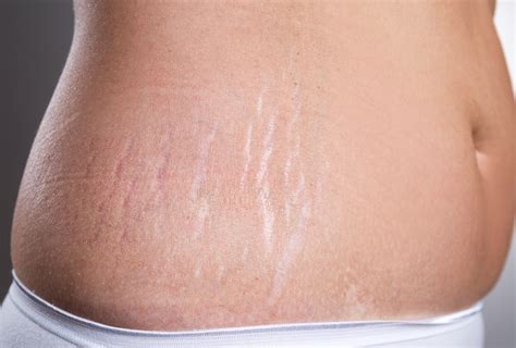 How To Get Rid Of Stretch Marks Home Treatment Prevention