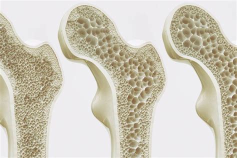 Osteoporosi Sintomi Cause E Trattamenti Farmacia Ram Dr Lanziner