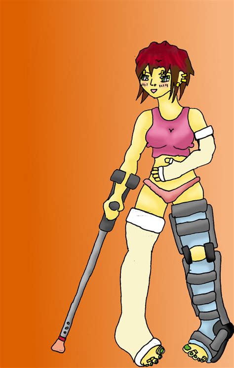 Llc Lac And Leg Brace By Castsandfeet On Deviantart