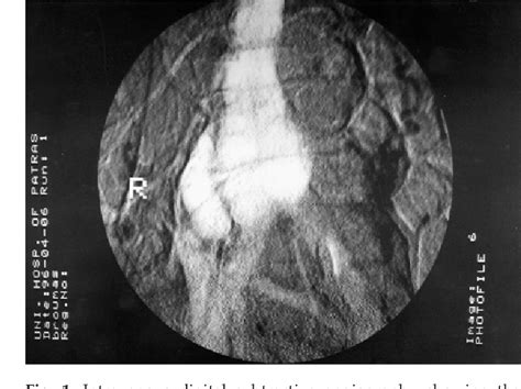Figure 1 From Review Article Aortocaval Fistula In Ruptured Aneurysms